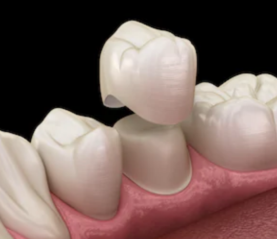 RCT + Post Core + Zirconia Crown (Full Package)
