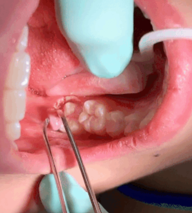 Operculectomy